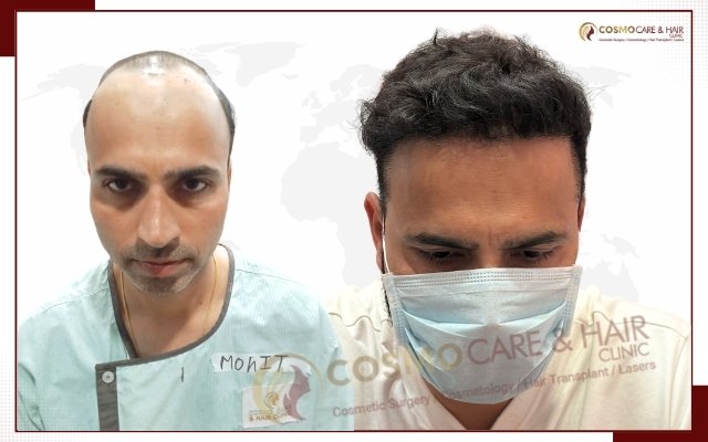 Before hair transplant, receding hairline